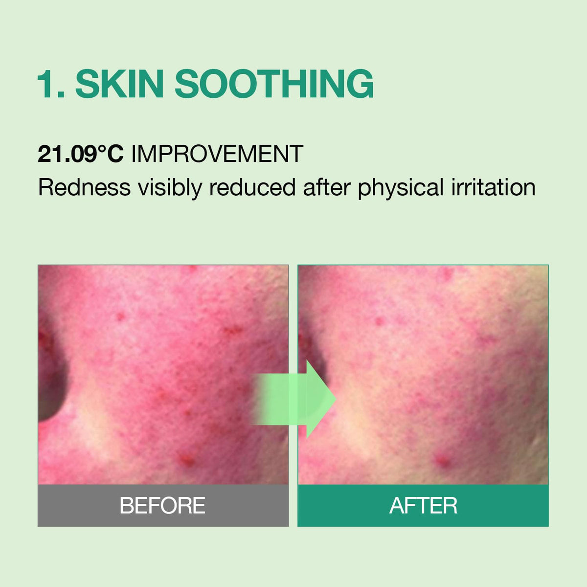 Cream for Acne-Prone & Sensitive Skin