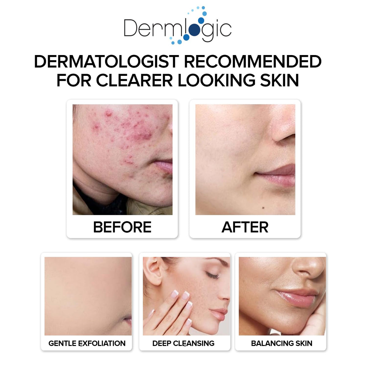 Acne Treatment Pads with Salicylic, Glycolic & Lactic Acid