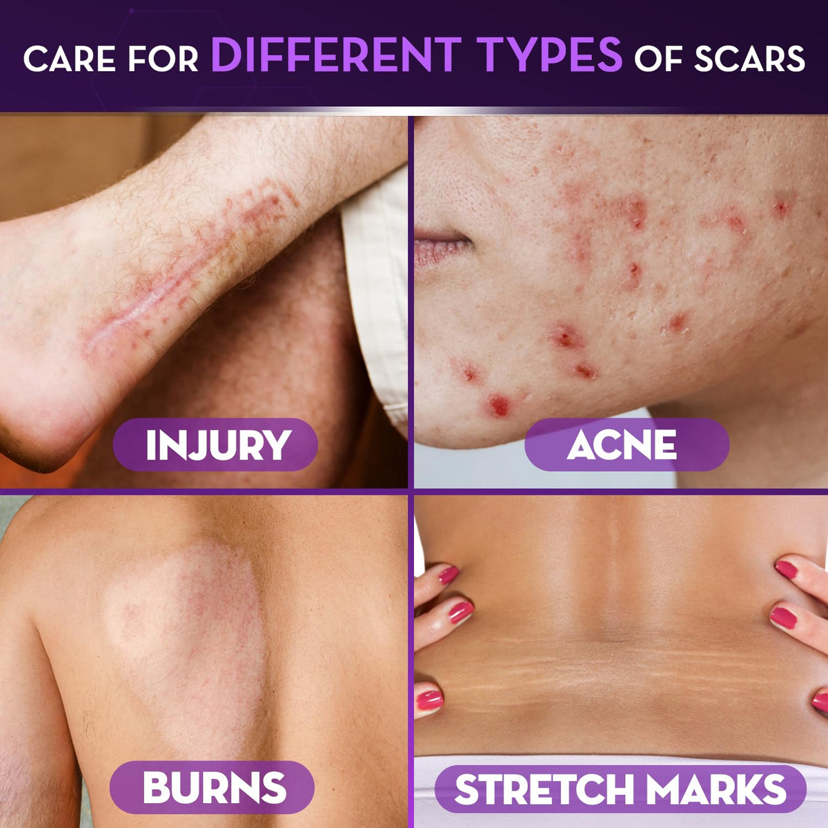 Cicatricure Advanced Scar Gel for Face and Body