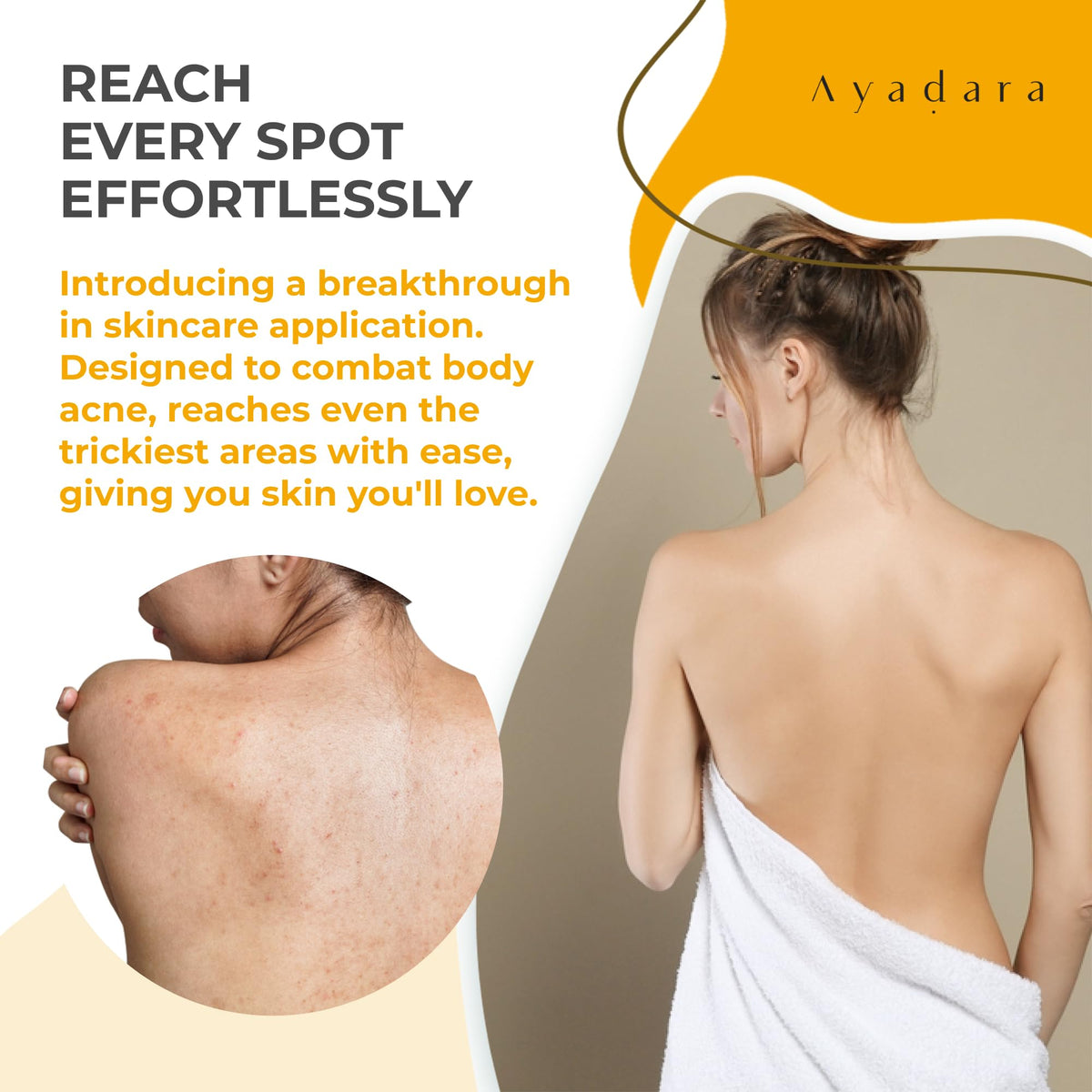 Ayadara 2% Salicylic Acid Acne Body Spray, Back & Body Acne, 3-Pack