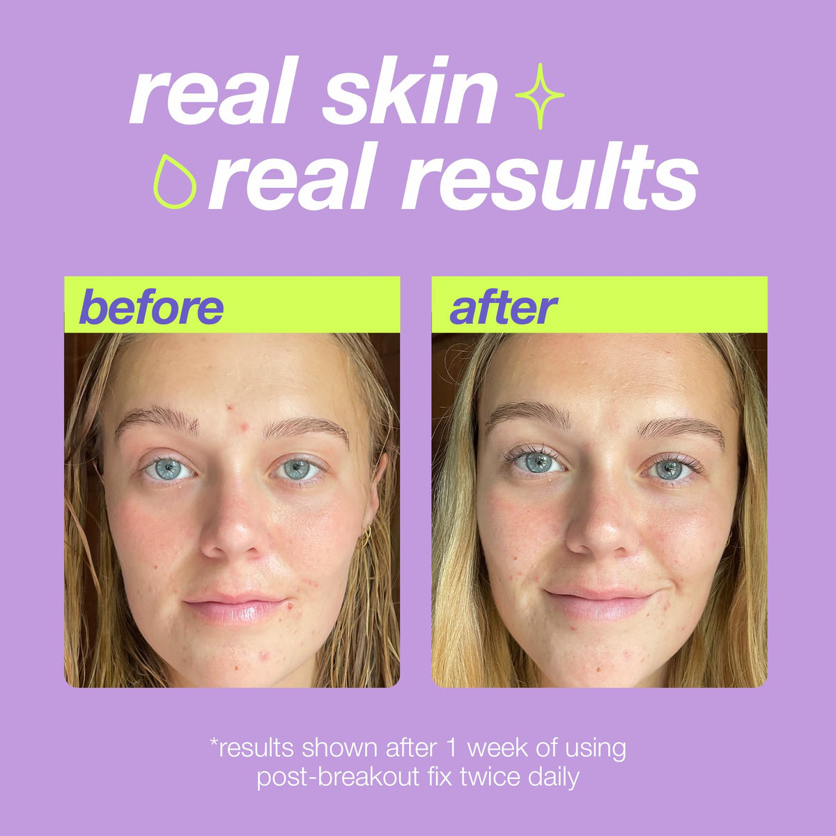 Dermalogica Clear Start Post-Breakout Fix Dark Spot Treatment