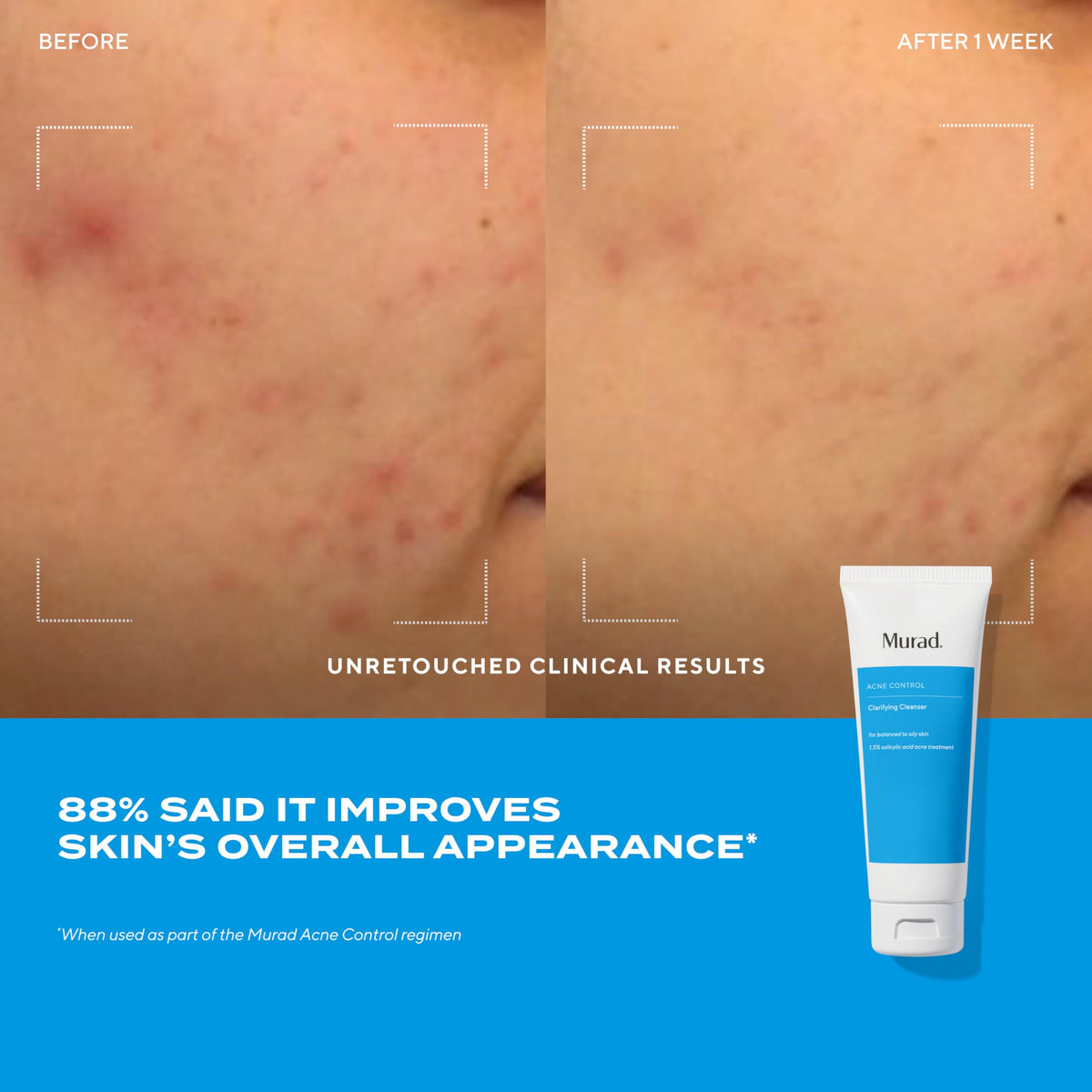 Murad Acne Treatment Trial Kit with Salicylic and Mandelic Acids