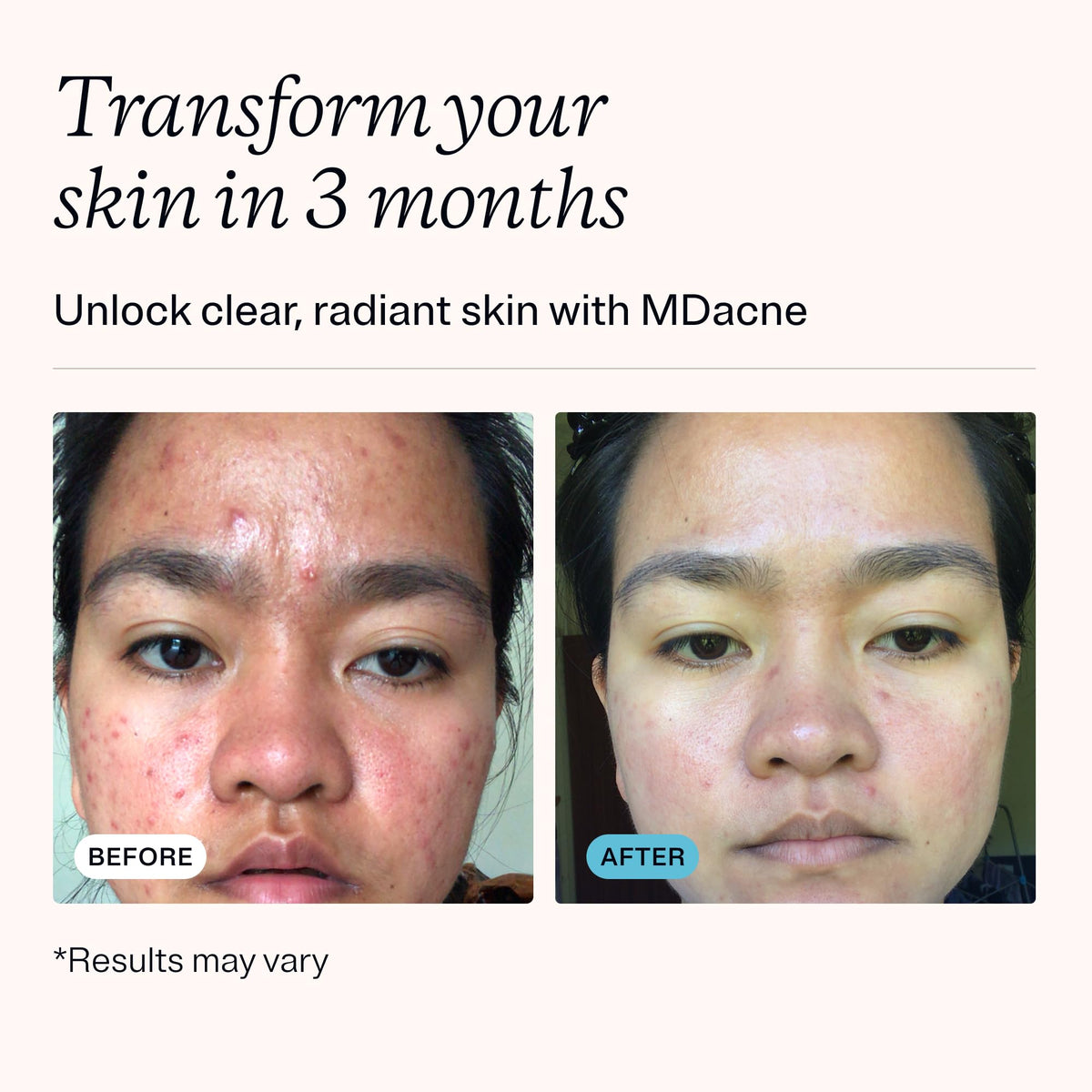 MDacne 3-Step Acne Treatment Kit with Benzoyl Peroxide and Salicylic Acid