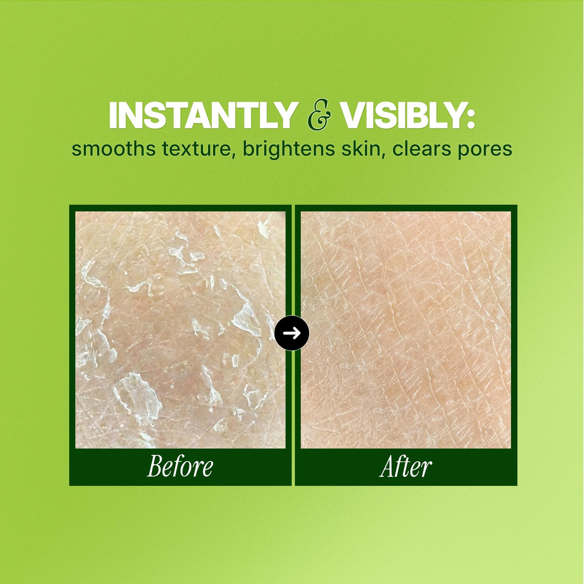 Ebanel AHA BHA Chemical Peel Gel with Glycolic and Salicylic Acid