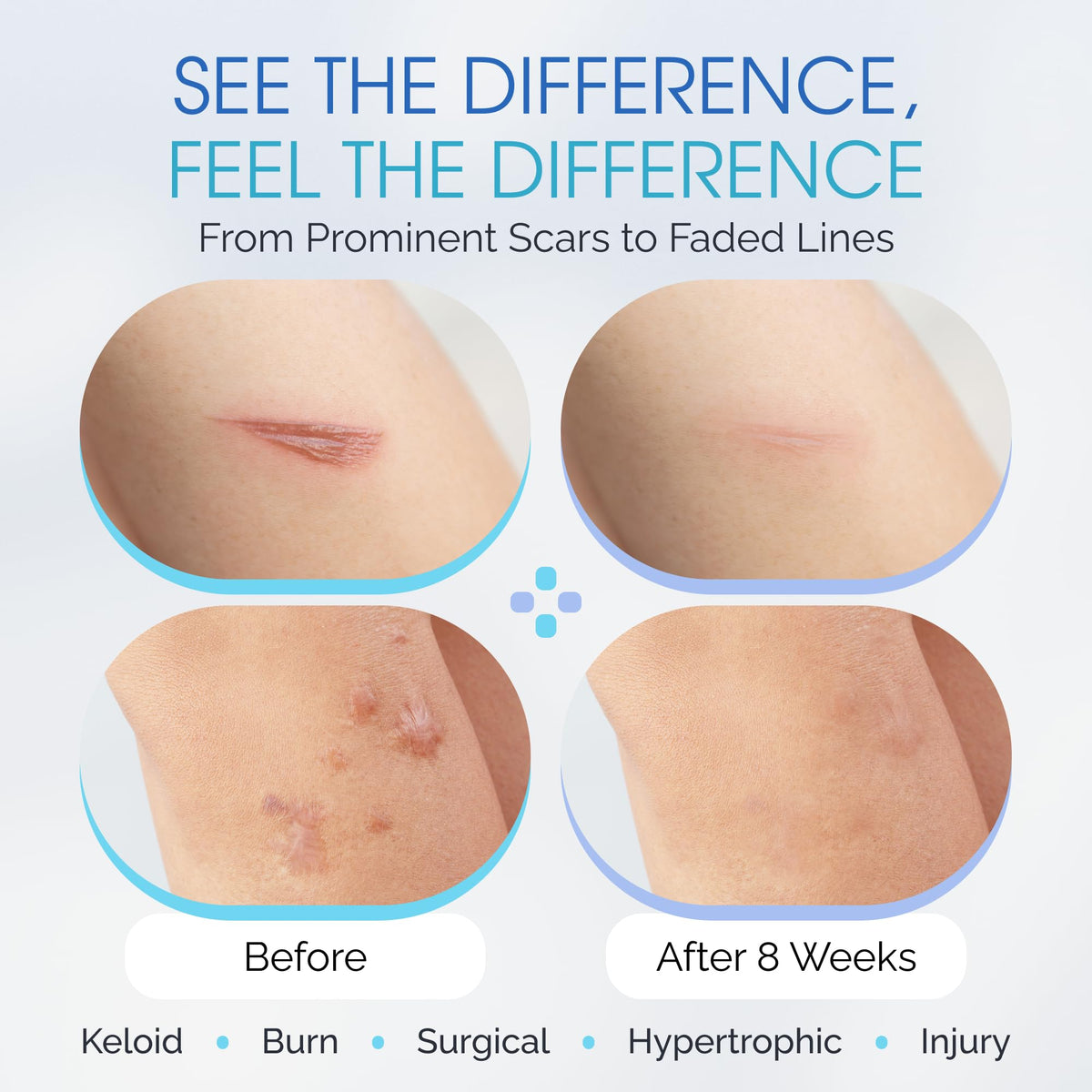 ScarScience Medical-Grade Silicone Scar Sheets