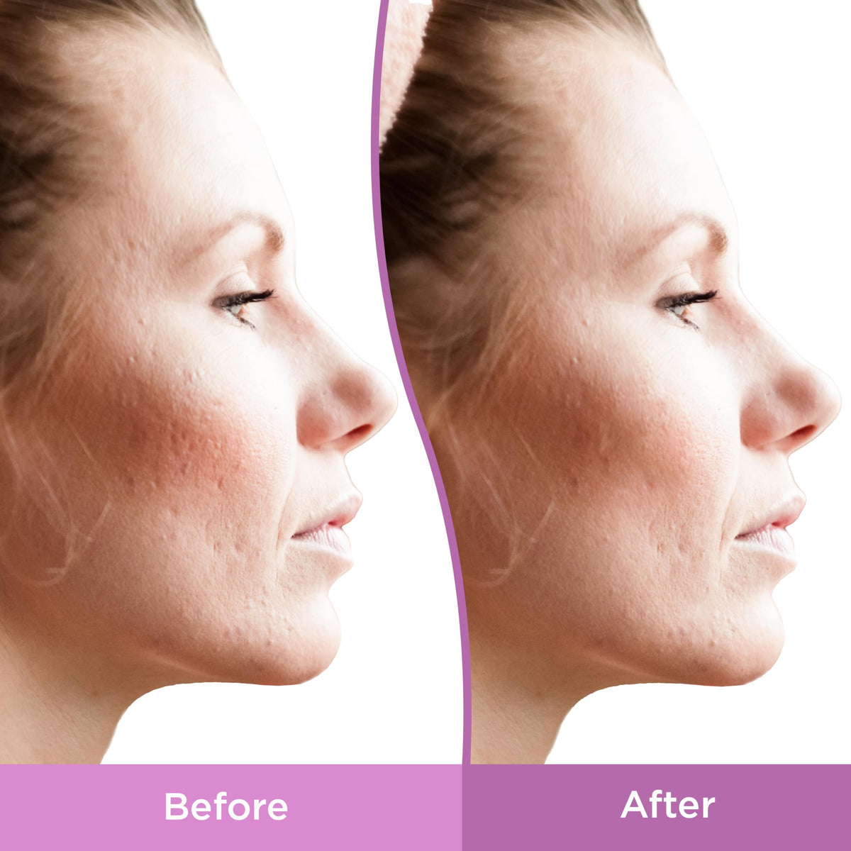 Differin Resurfacing Scar Gel for Uneven, Textured Skin