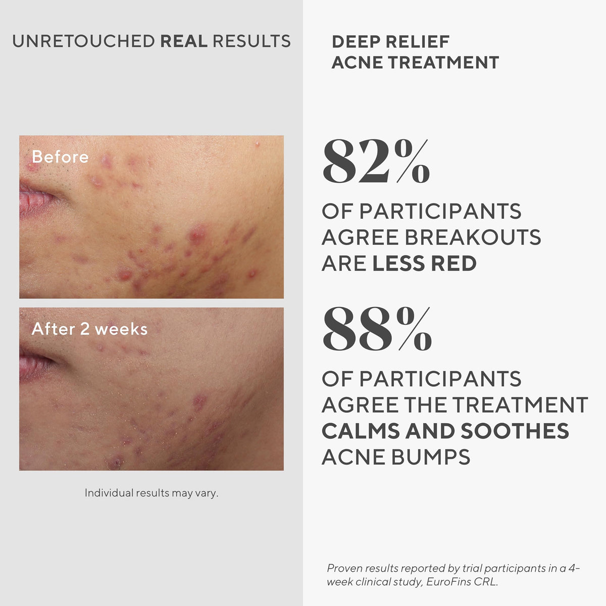 Murad Deep Relief Acne Spot Treatment with 2% Salicylic Acid, 1 Fl Oz