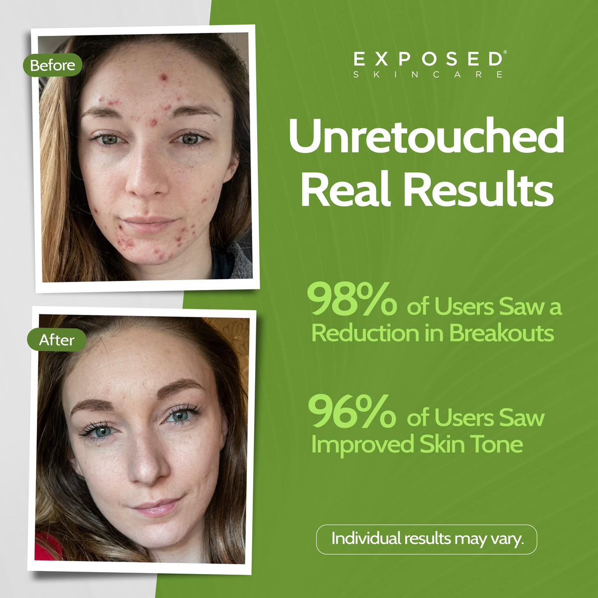 Exposed Skin Care Acne Treatment Kit