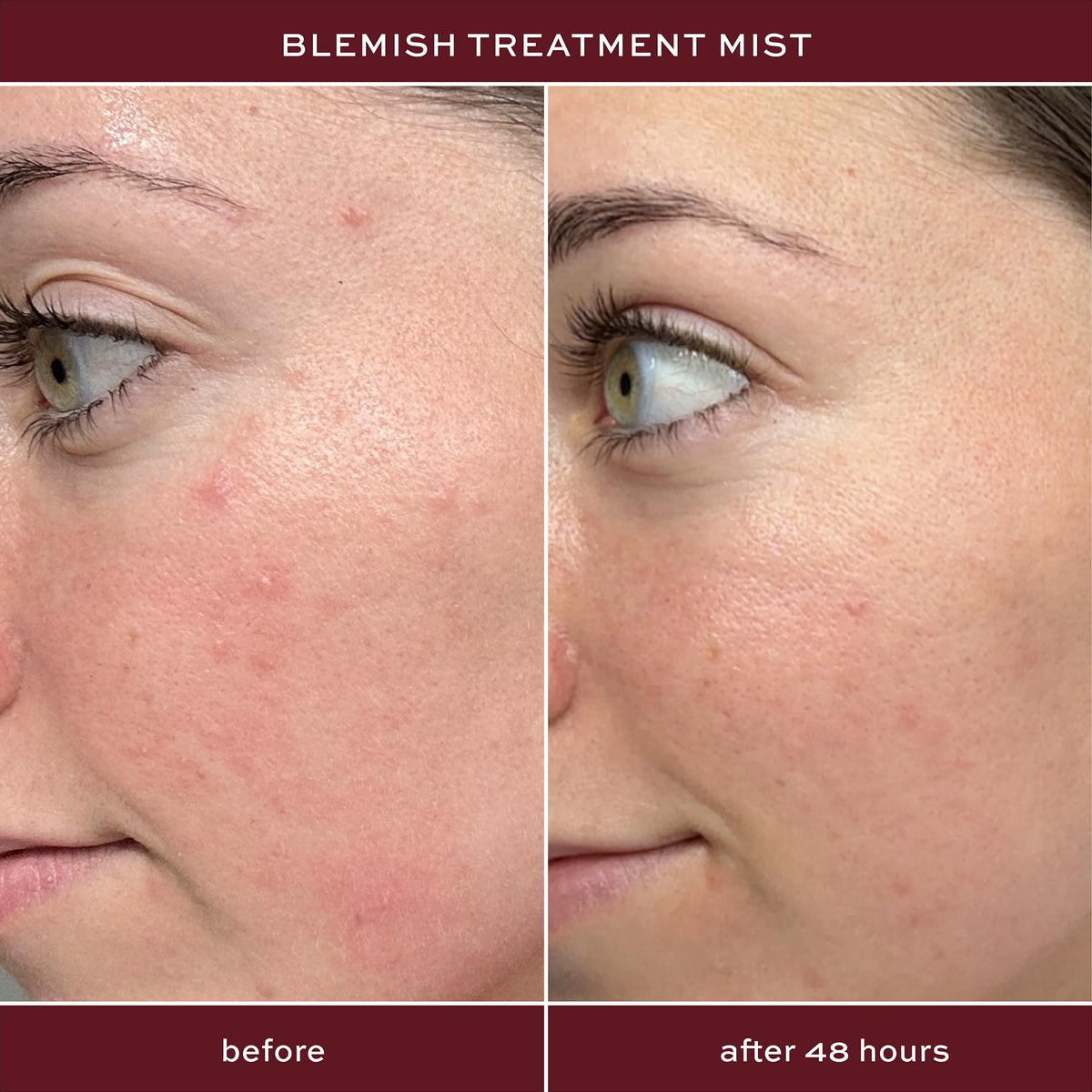 ITK Acne Treatment Trio with Blemish Mist, Spot Treatment & Pore Scrub