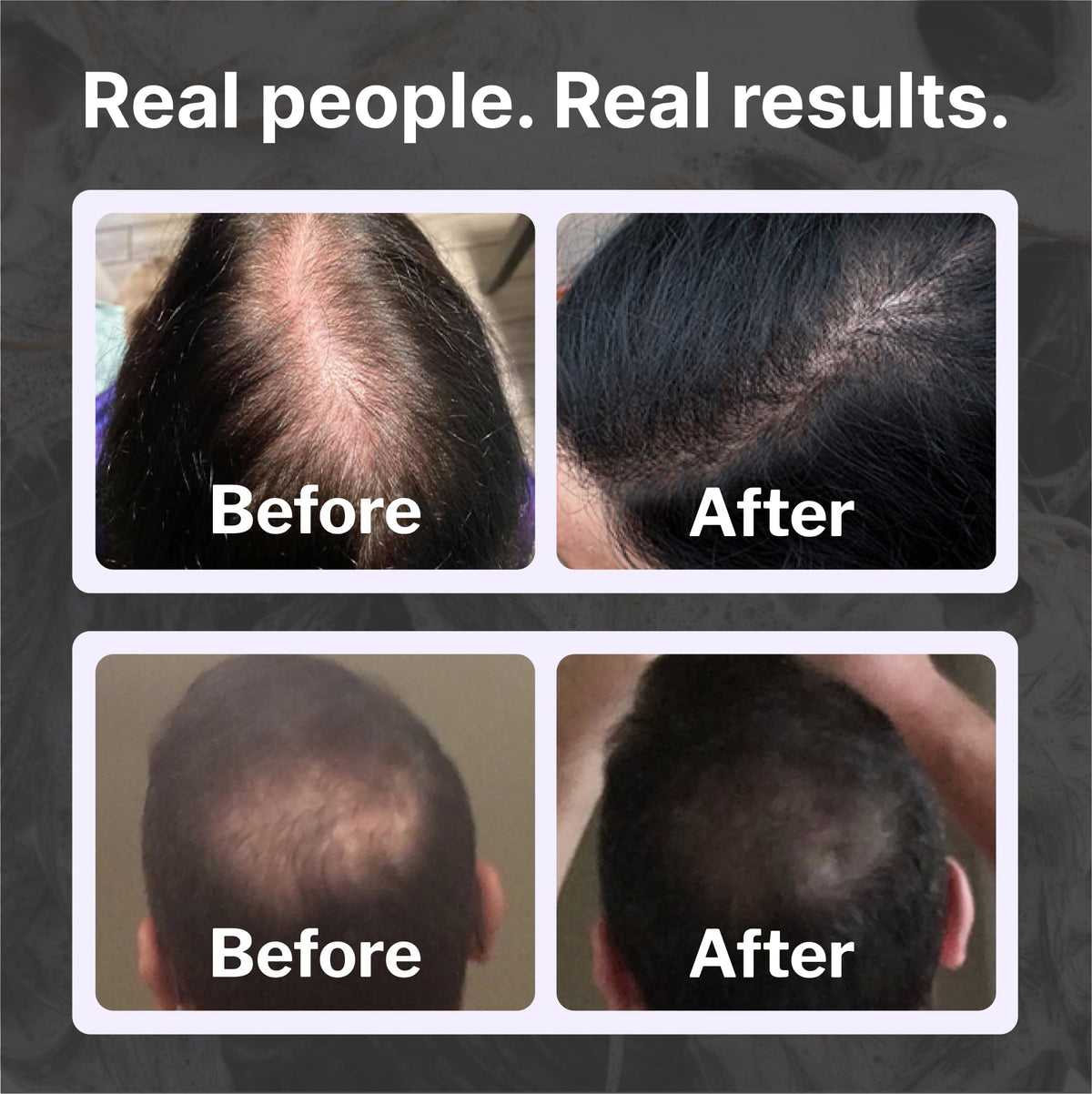 Shapiro MD DHT-Fighting Hair Loss Shampoo for Thicker-Looking Hair