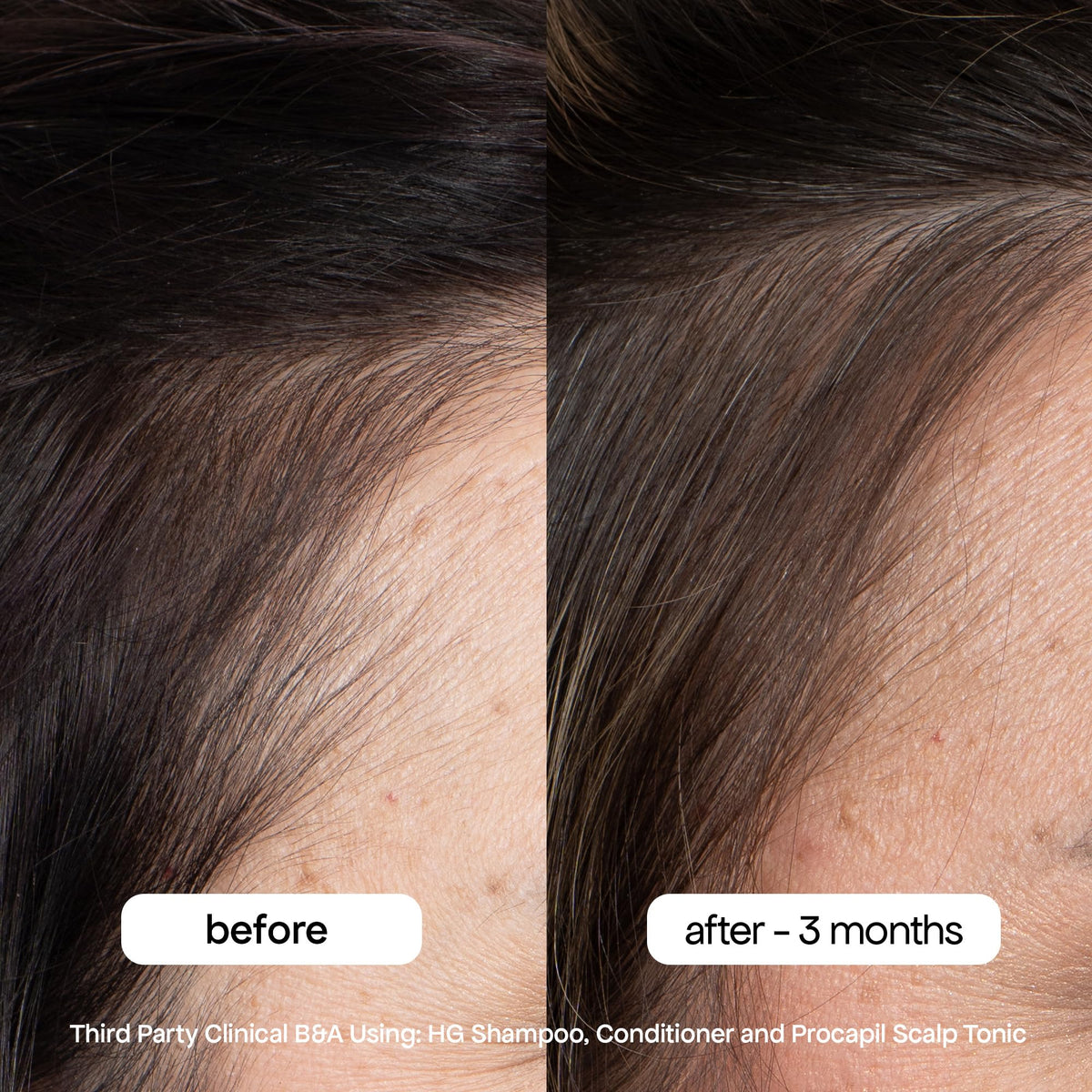 BondiBoost HG Anti-Thinning Shampoo and Conditioner Set